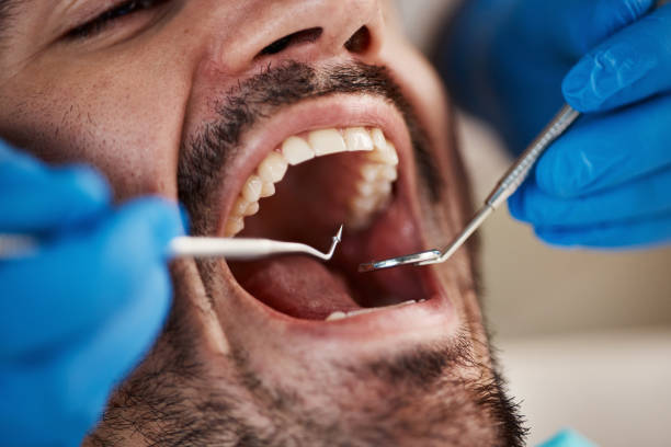 Best Broken or Cracked Tooth Emergency Dentist in Forest Meadows, CA